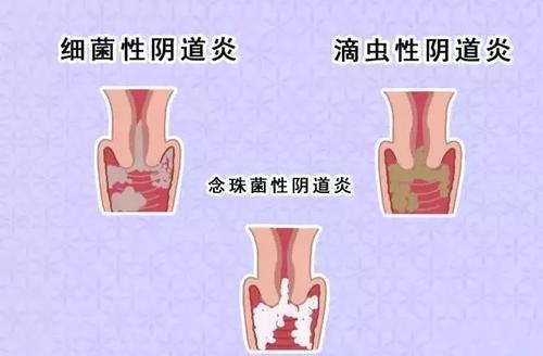 阴道口痒怎么回事