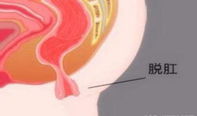 脱肛是什么原因造成的