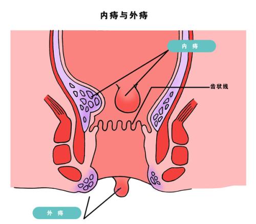 痔疮疼痛怎样缓解