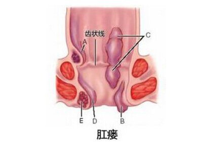 肛瘘手术后吃什么伤口愈合快