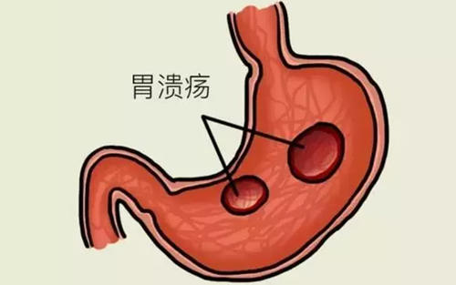 胃溃疡