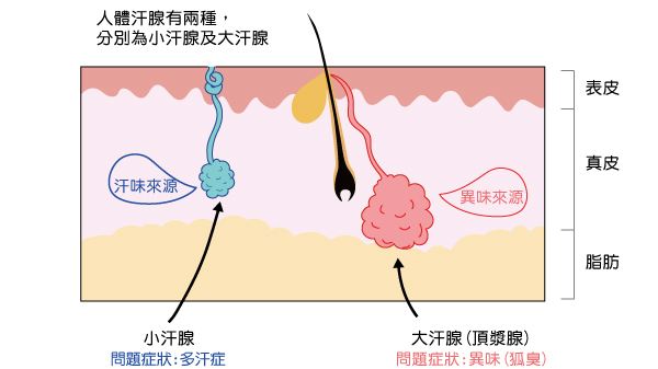 狐臭手术多少钱