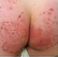 肛门瘙痒的原因