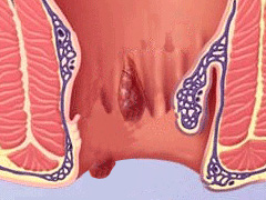 便后有肿物脱出如何治疗有效