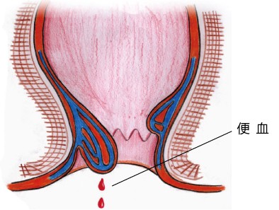 大便出血是什么问题